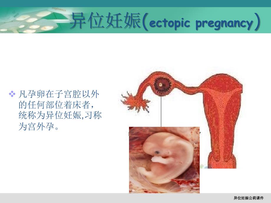 异位妊娠公莉课件_第2页