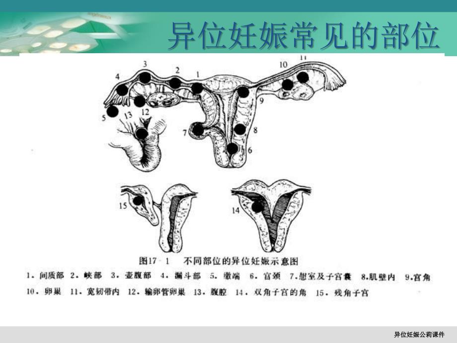 异位妊娠公莉课件_第4页