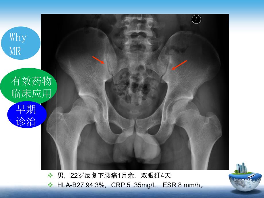 SpA骶髂关节炎的影像学诊断与鉴别诊断_第4页