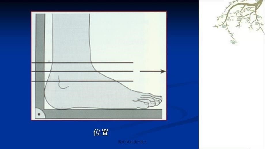 踝关节MRI读片要点课件_第5页