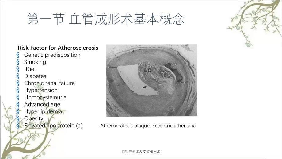 血管成形术及支架植入术_第5页