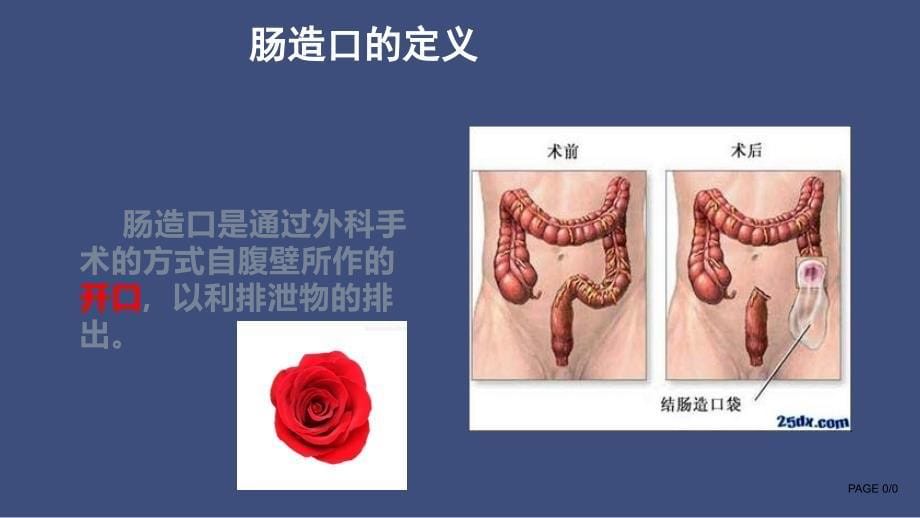 肠造口护理小讲课.ppt_第5页