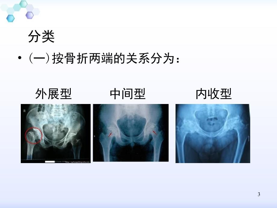 股骨颈骨折骨一科_第3页