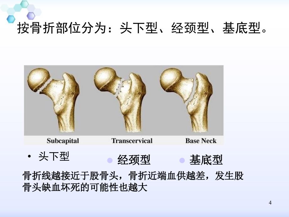 股骨颈骨折骨一科_第4页