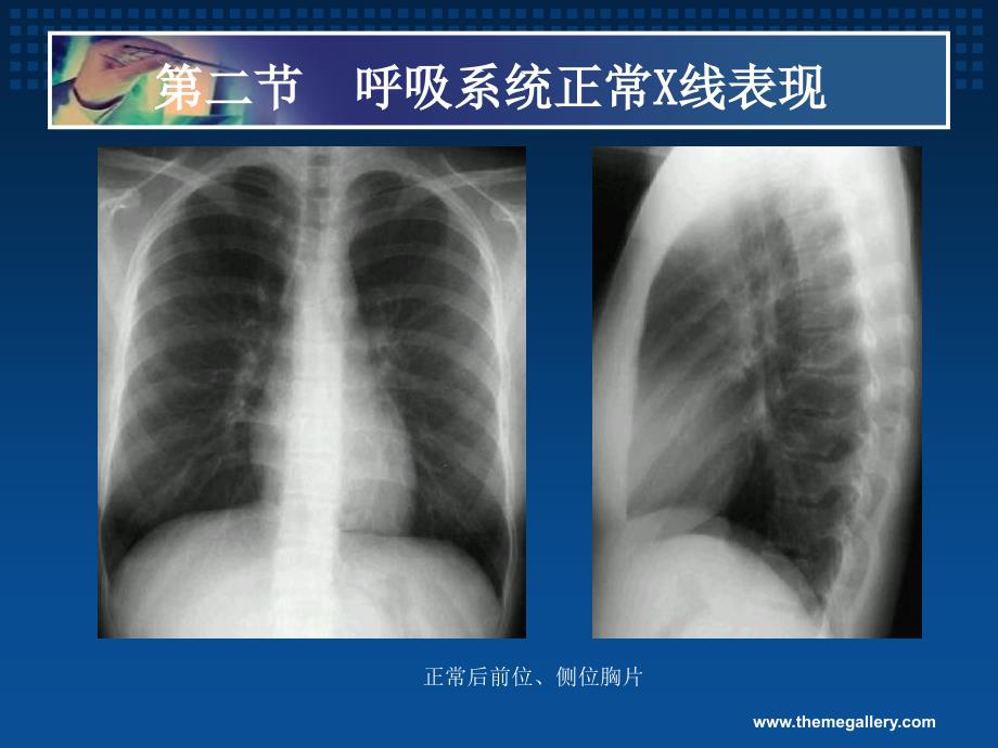 胸部疾病基本X线表现_第2页