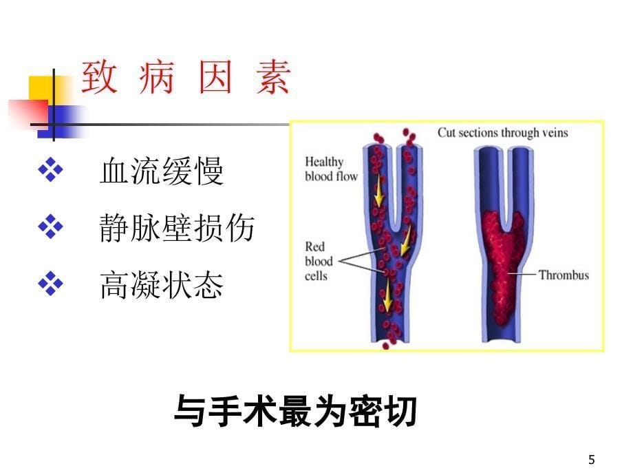 骨科大手术DVT预防PPT优秀课件_第5页