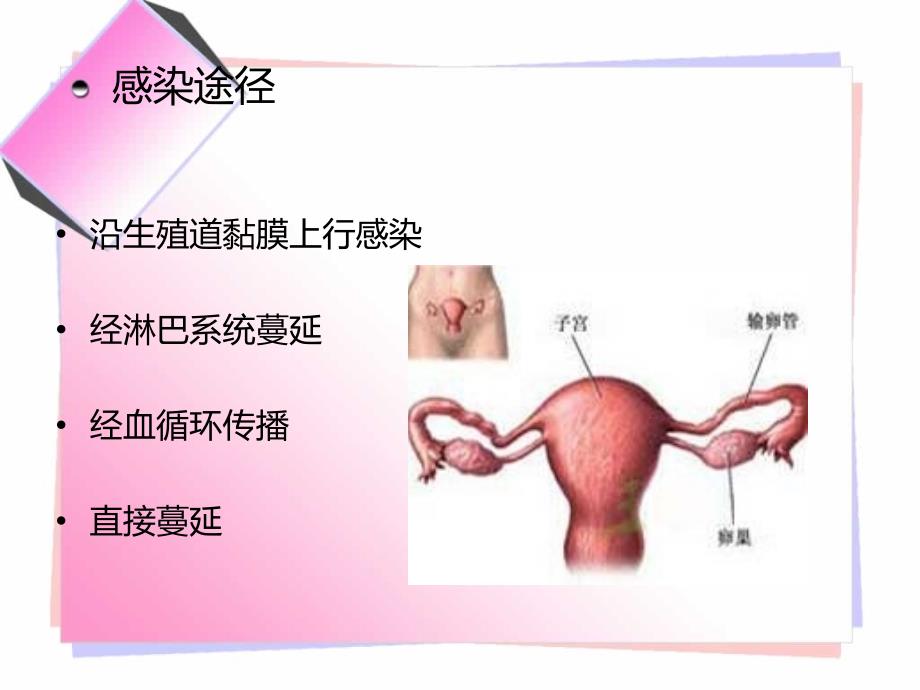 急慢性盆腔炎.ppt_第4页