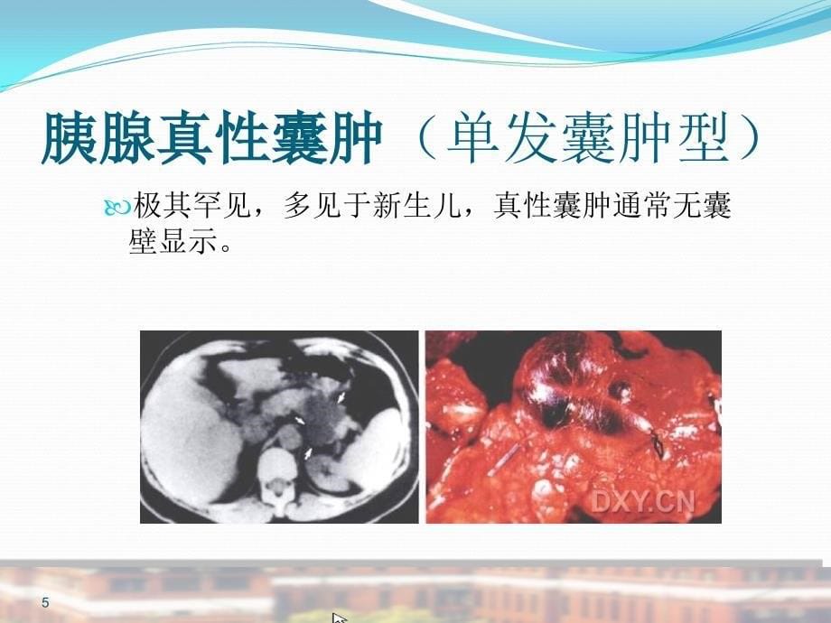 胰腺囊性病变PPT课件_第5页