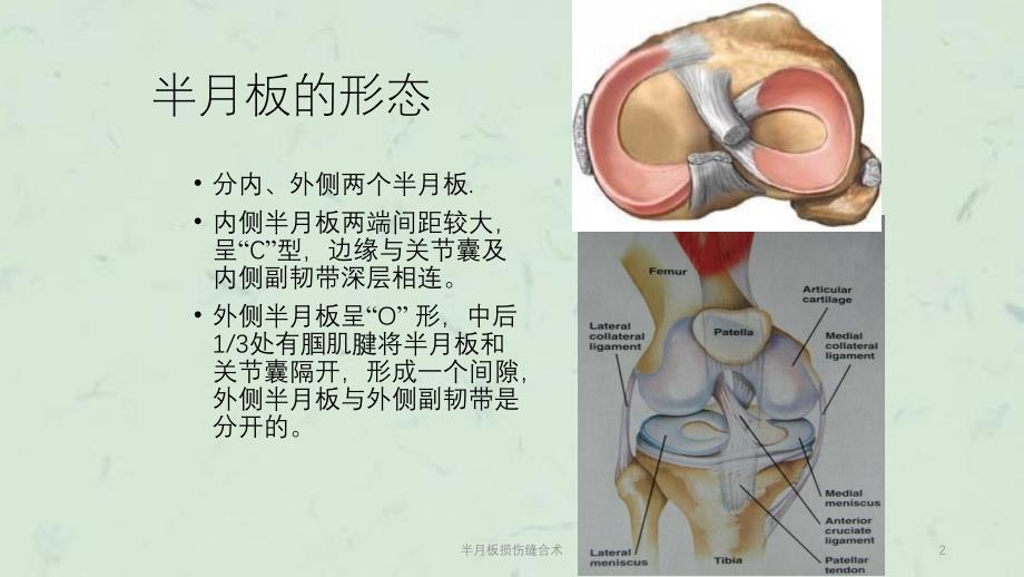 半月板损伤缝合术课件_第2页