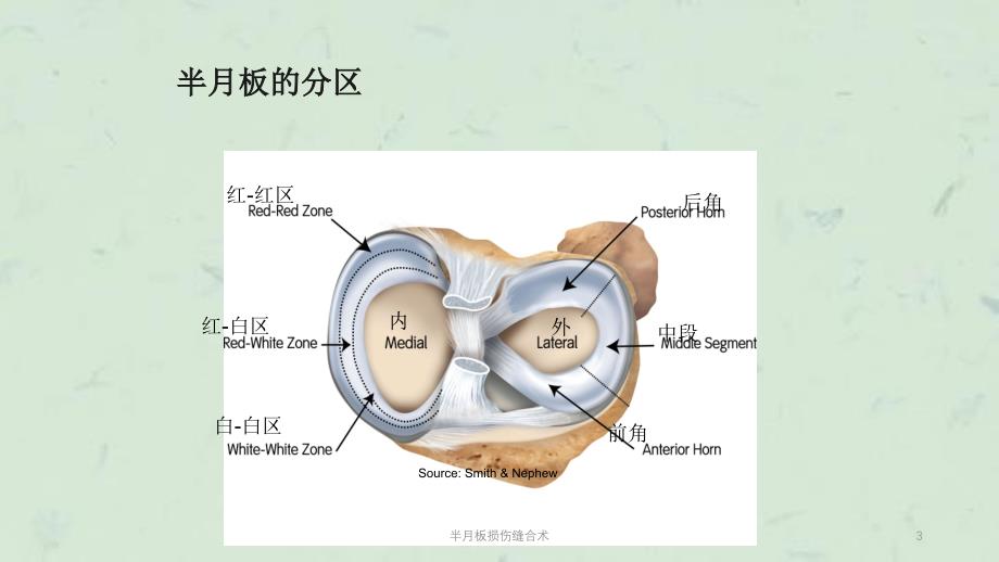 半月板损伤缝合术课件_第3页