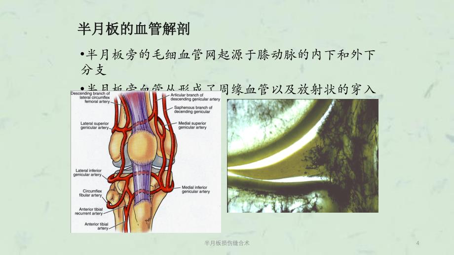 半月板损伤缝合术课件_第4页