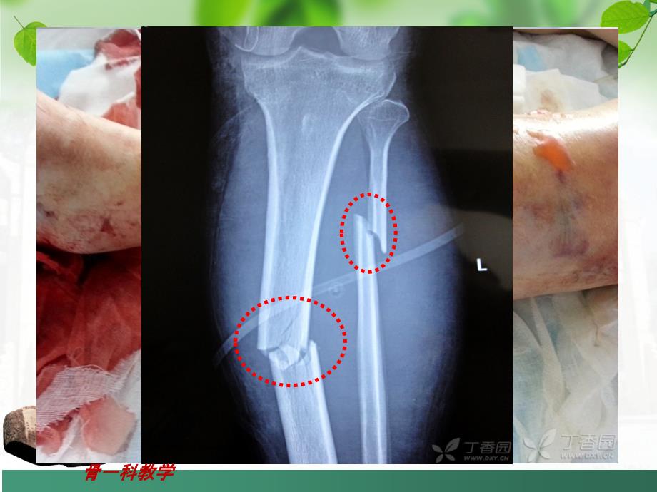 骨筋膜室综合症课件_第4页