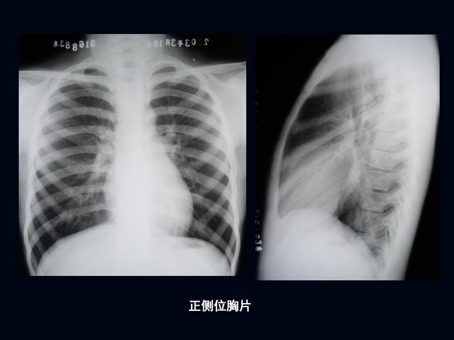 儿童胸部影像学PPT课件_第5页