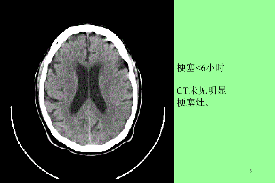 脑栓塞护理查房文档资料_第3页