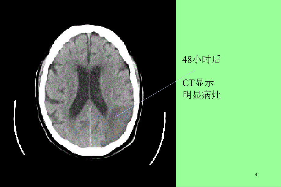 脑栓塞护理查房文档资料_第4页