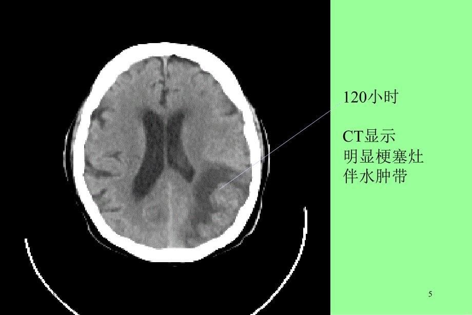 脑栓塞护理查房文档资料_第5页