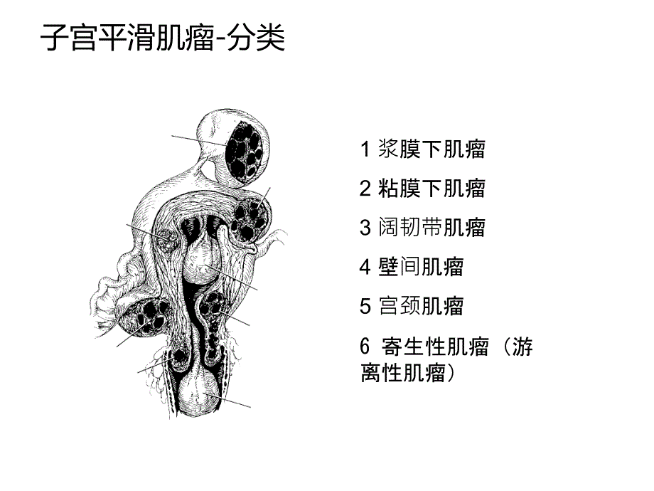 微创手术治疗子宫肌瘤_第4页