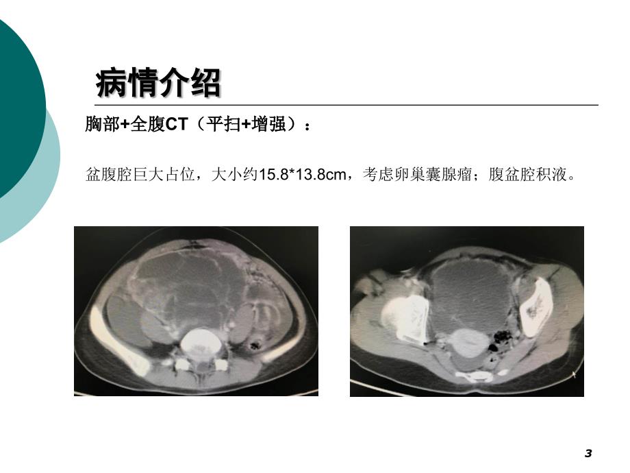 巨和粒应用病例分享ppt参考课件_第3页