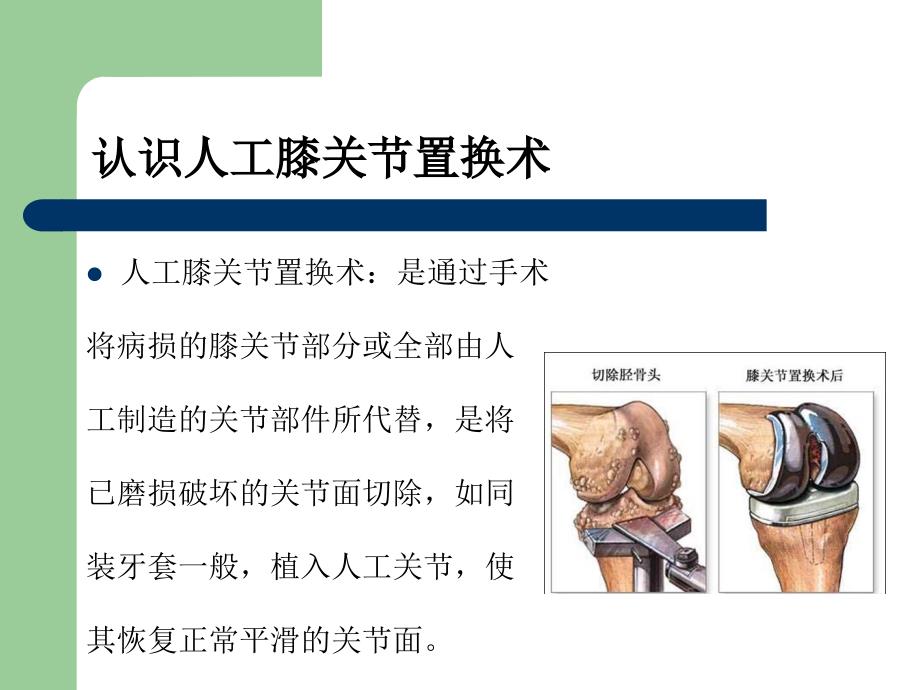 人工膝关节置换术治疗骨性关节炎的护理查房课件_第4页