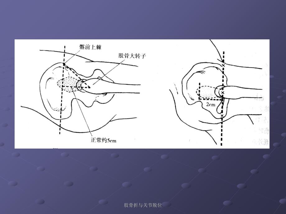 肢骨折与关节脱位课件_第4页