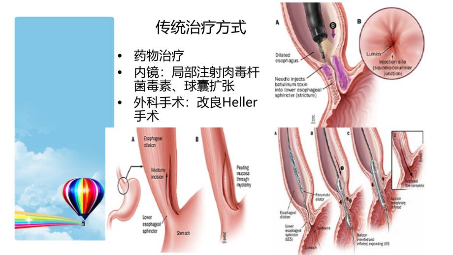 poem术的治疗与护理.ppt_第4页