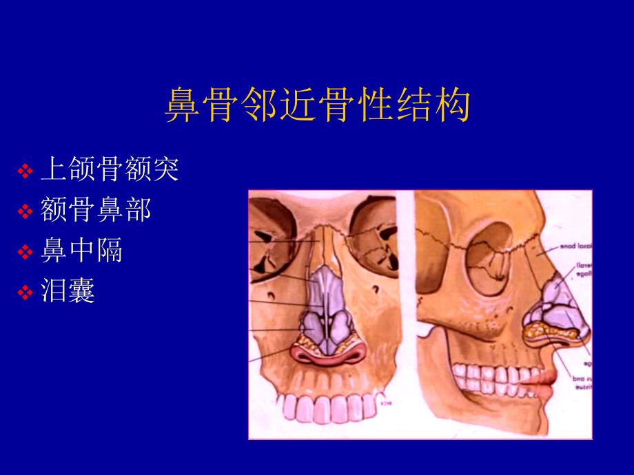 鼻骨骨折影像学诊断_第3页