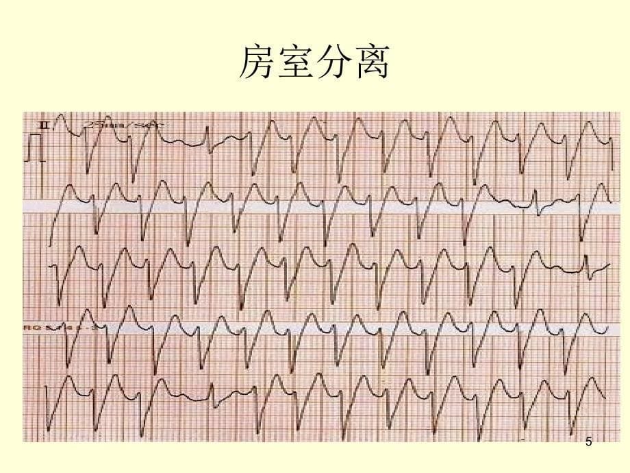 宽QRS波心动过速的鉴别诊断优秀课件_第5页