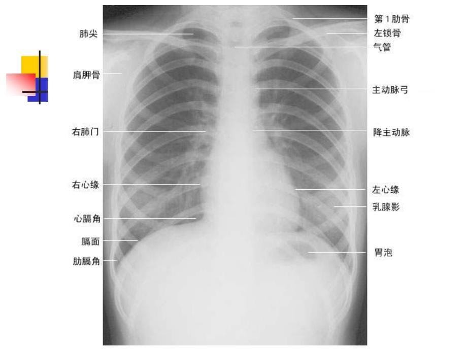 正常胸片胸部CT阅读课件_第5页