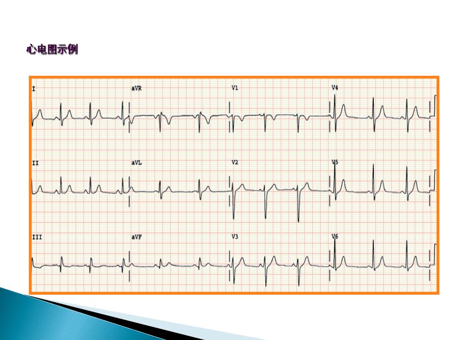 心电图检查ppt课件_第4页