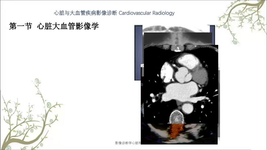 影像诊断学心脏和大血管_第2页