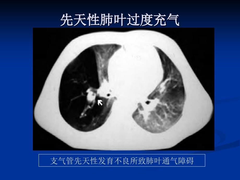 小儿胸部发育异常的影像诊断课件_第5页