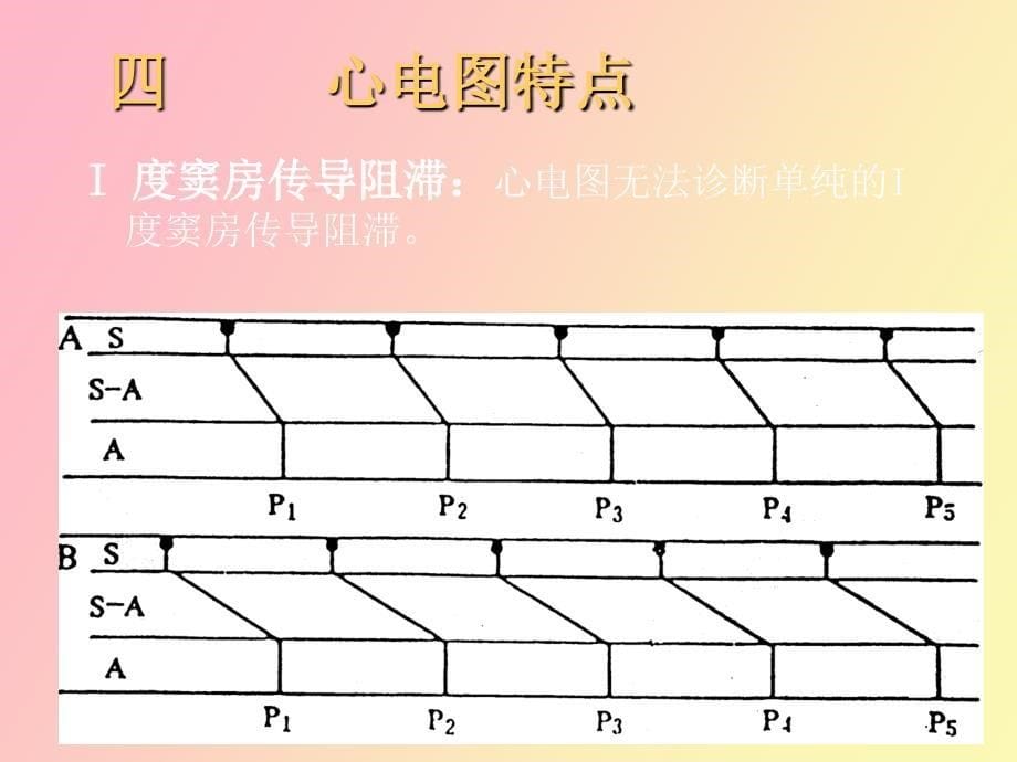 传导阻滞分析_第5页