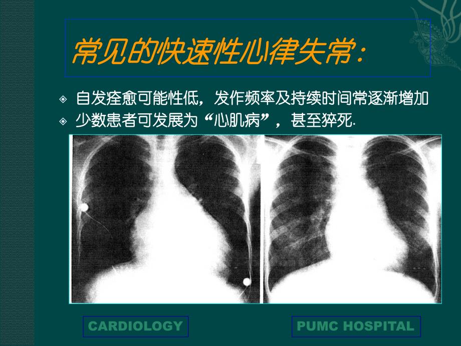 快速性心律失常PPT课件_第4页