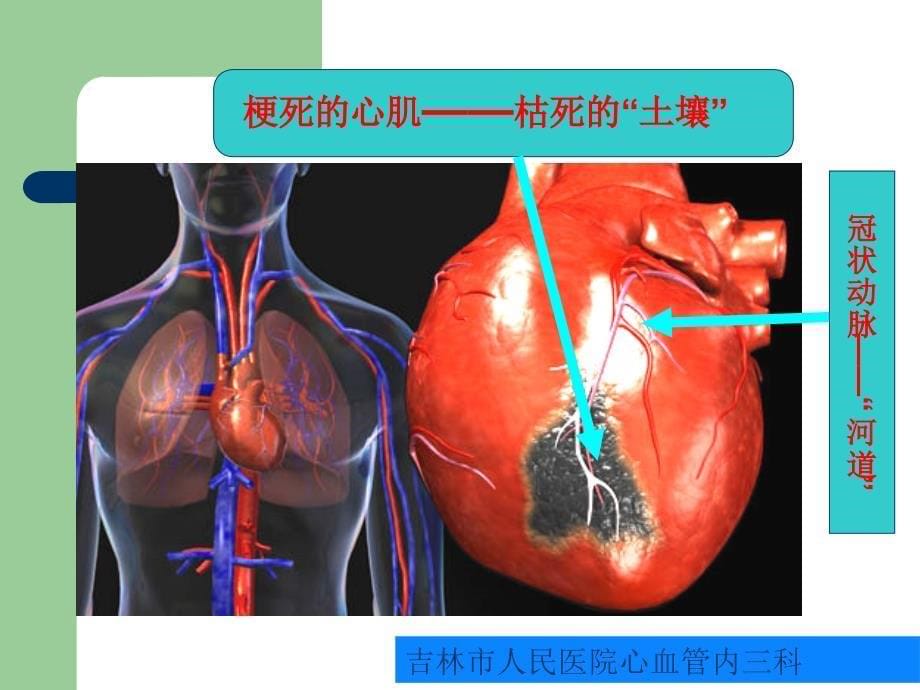 冠心病健康教育.ppt_第5页