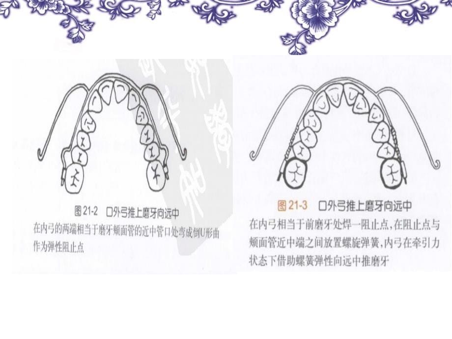 牙列拥挤——推磨牙向远中_第5页