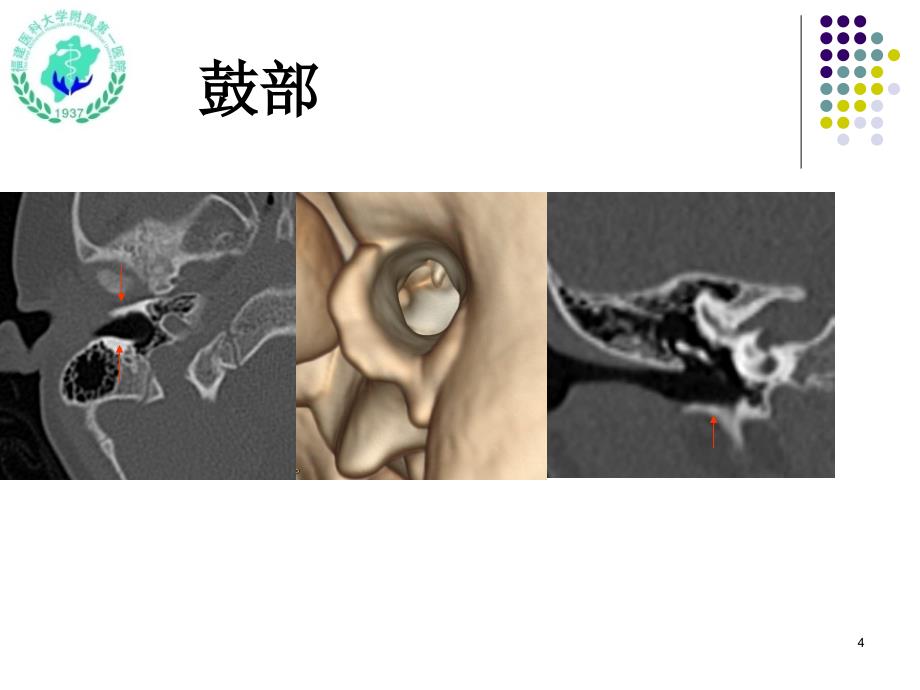 耳颞部影像解剖PPT参考幻灯片_第4页