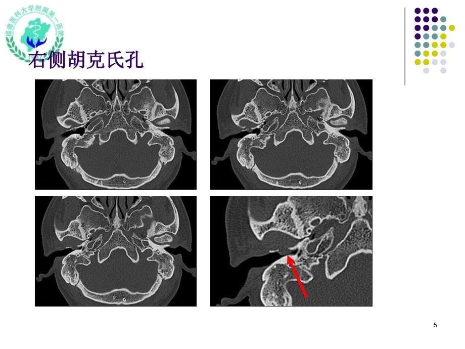 耳颞部影像解剖PPT参考幻灯片_第5页