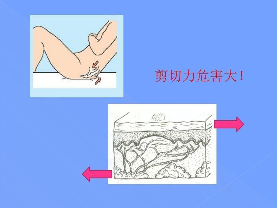 压力性损伤指南要点学习_第5页