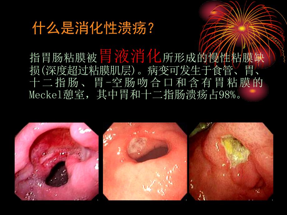 《消化性溃疡内科》PPT课件_第2页