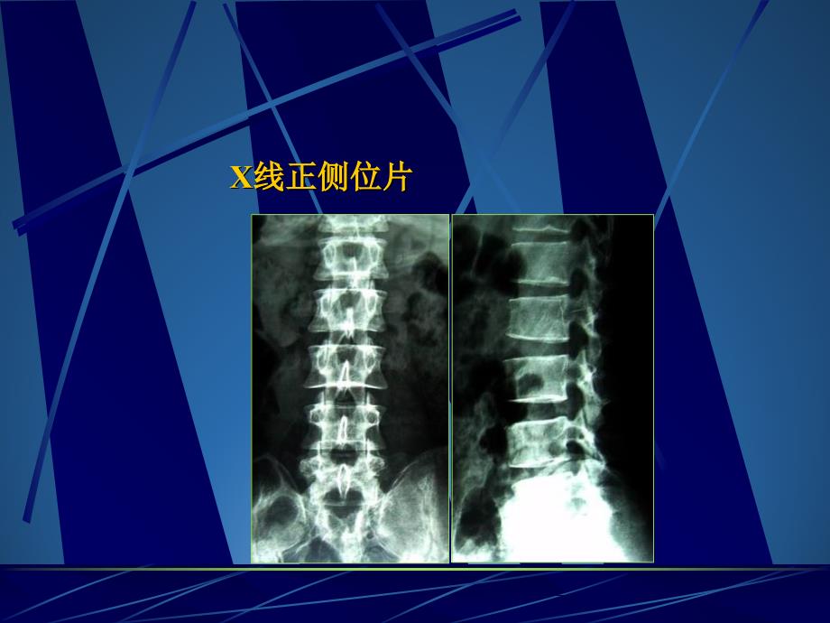 医学课件腰椎间盘突出症的手术治疗_第3页