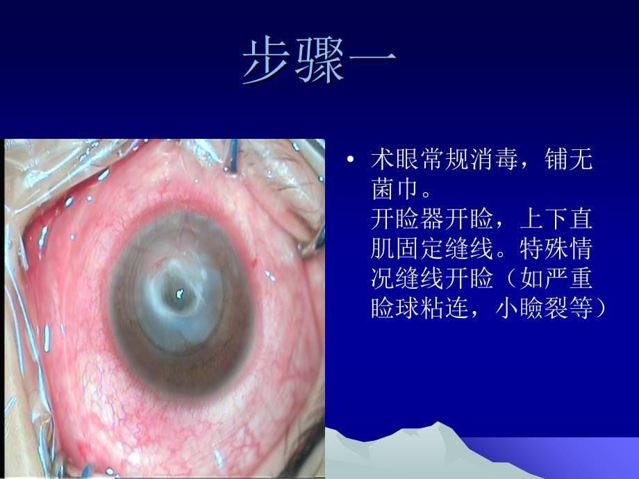 角膜移植手术操作步骤_第5页