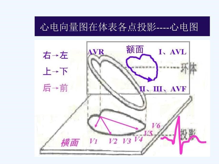 常见心电图诊断要点课件_第5页