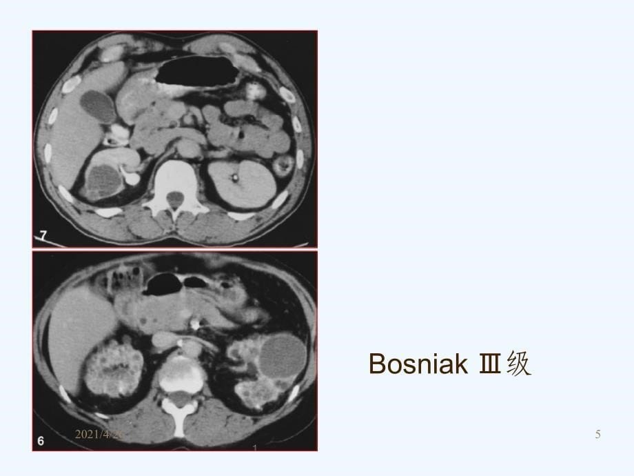 肾囊性病变的影像学表现_第5页