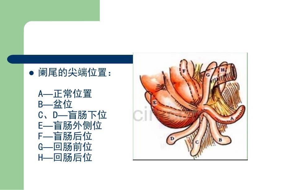 急性阑尾炎影像诊断学.ppt_第5页