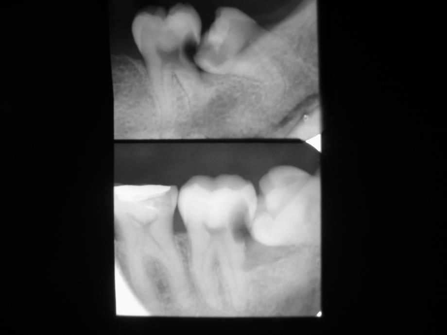 口腔影像学：第5章 牙及牙周疾病_第4页