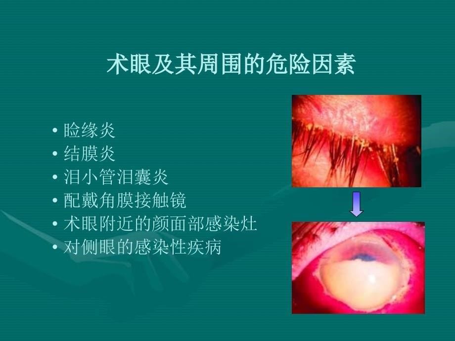 白内障术中预防细菌性眼内炎的意识和策略_第5页