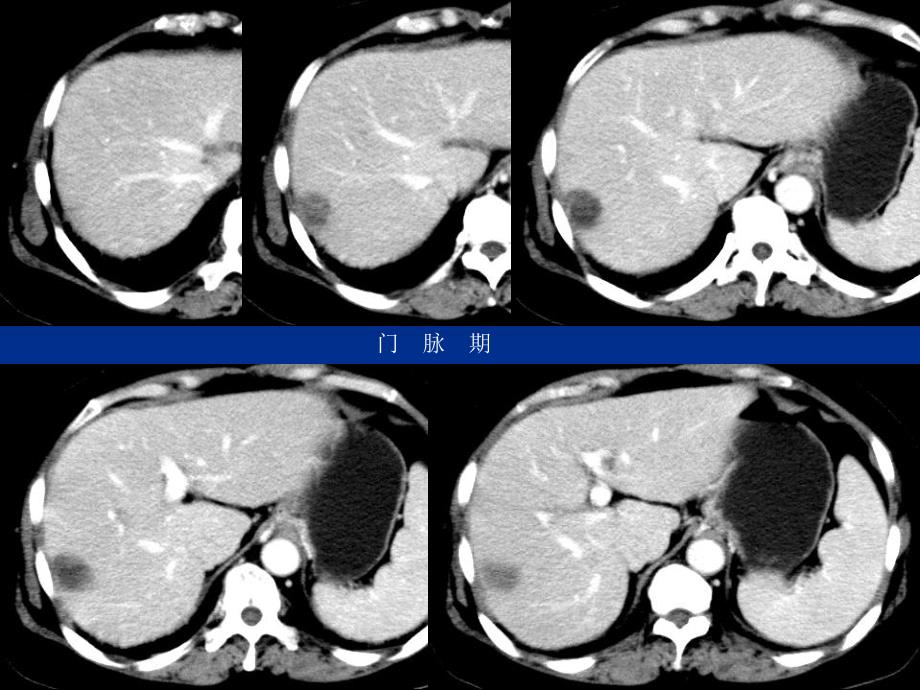 最新肝细胞癌伴坏死病例随访PPT文档_第3页