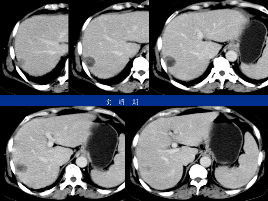 最新肝细胞癌伴坏死病例随访PPT文档_第4页