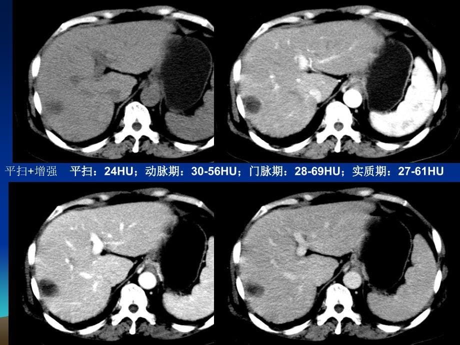 最新肝细胞癌伴坏死病例随访PPT文档_第5页