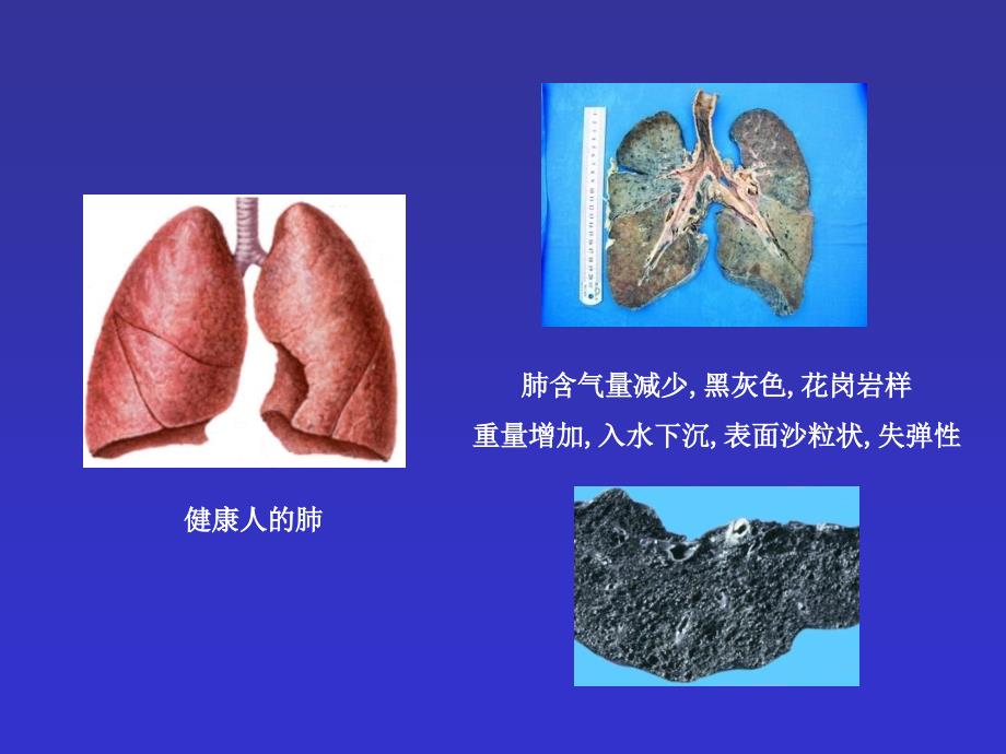 尘肺患者保健常识讲座.ppt_第4页